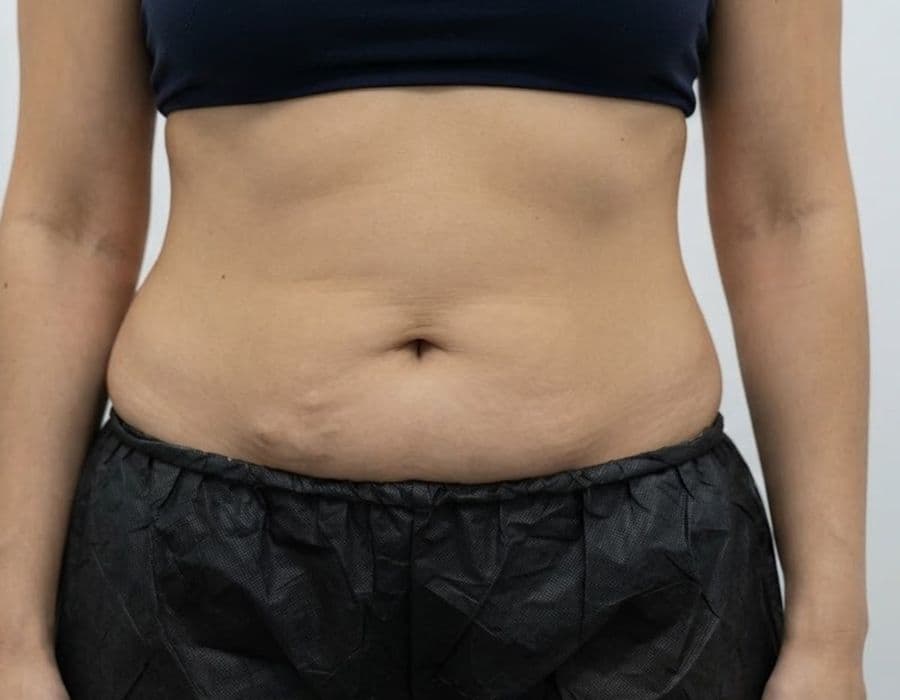 BodySculpt (FMS) - before treatment